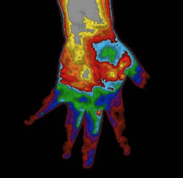Thermography