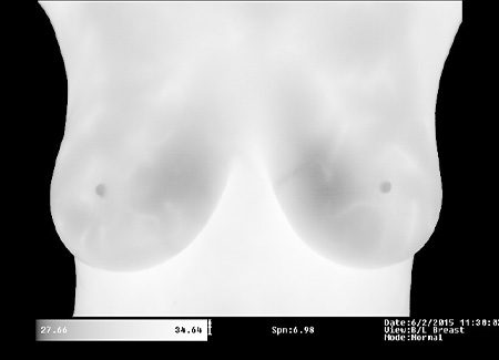 Breast Thermography