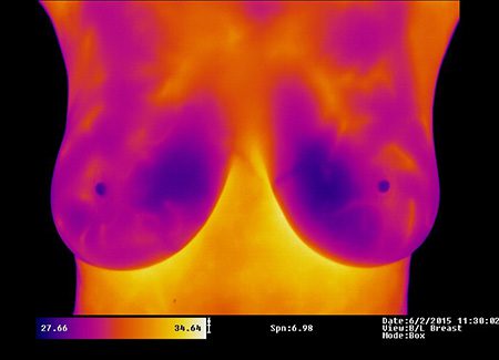Breast Thermography | Innovative Health Wellness Group