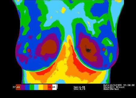 PET, CT Scans, and Thermagraphy for Breast Cancer Imaging