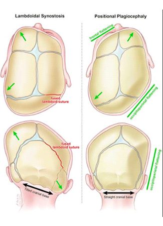 plagiocephaly flat head syndrome in infants