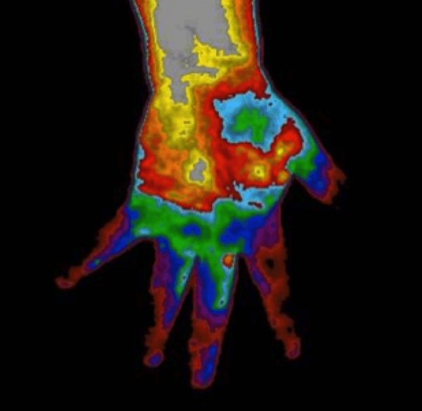Thermal Scan Of Hand For Early Diabetes Detection